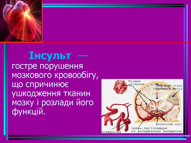 Інсульт  — гостре порушення мозкового кровообігу, що спричинює ушкодження тканин мозку і розлади